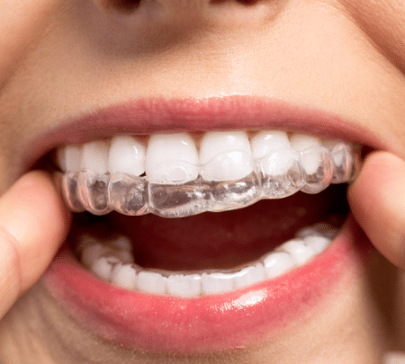 9 Reasons To Get Invisalign In Brentwood