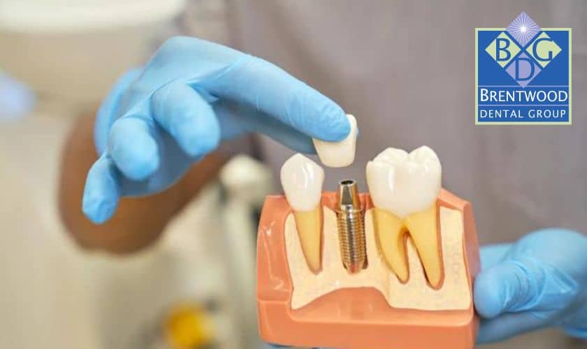 How To Take Care For All On Four Dental Implants