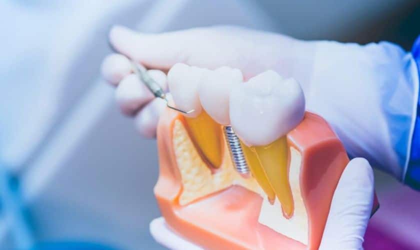 Dental Implants in Bretwood - Brentwood Dental Group