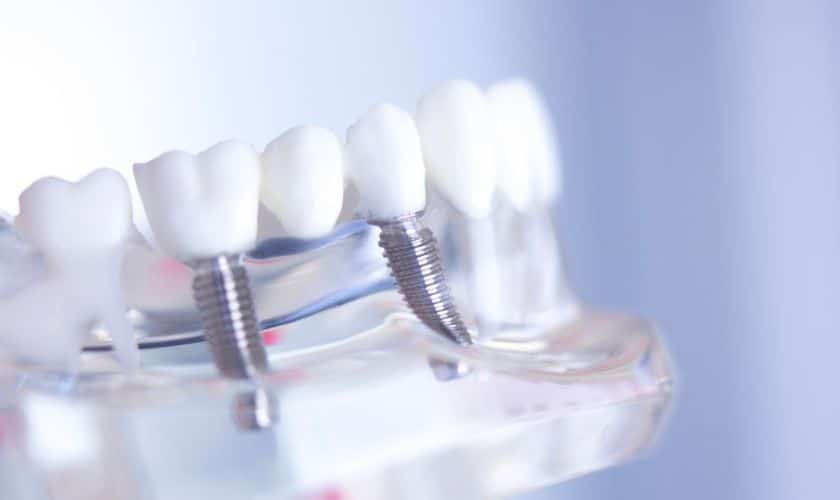 Dental Implants