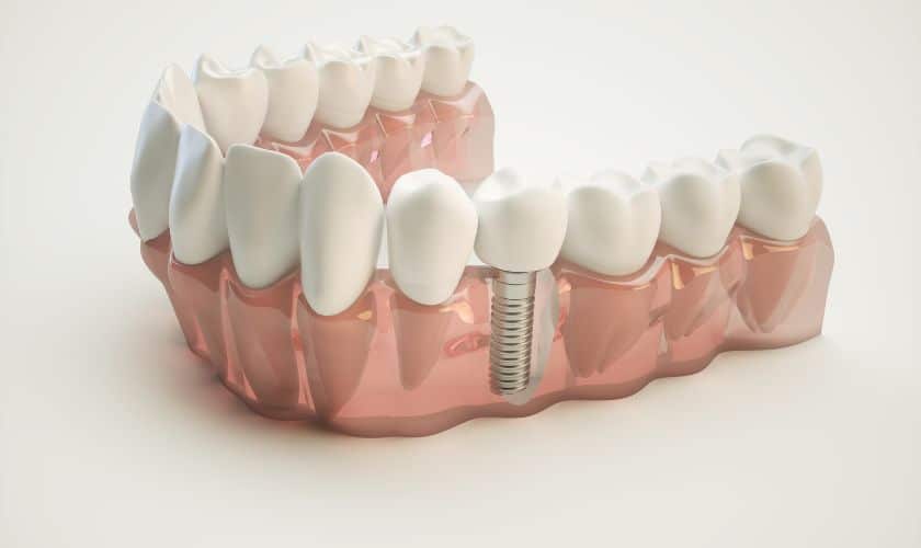 Patients Ask About Pain Before Implant Surgery