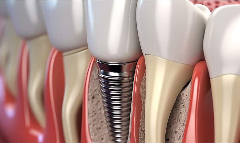 Dental implant cross-section showing screw fixture embedded in jawbone with crown restoration.