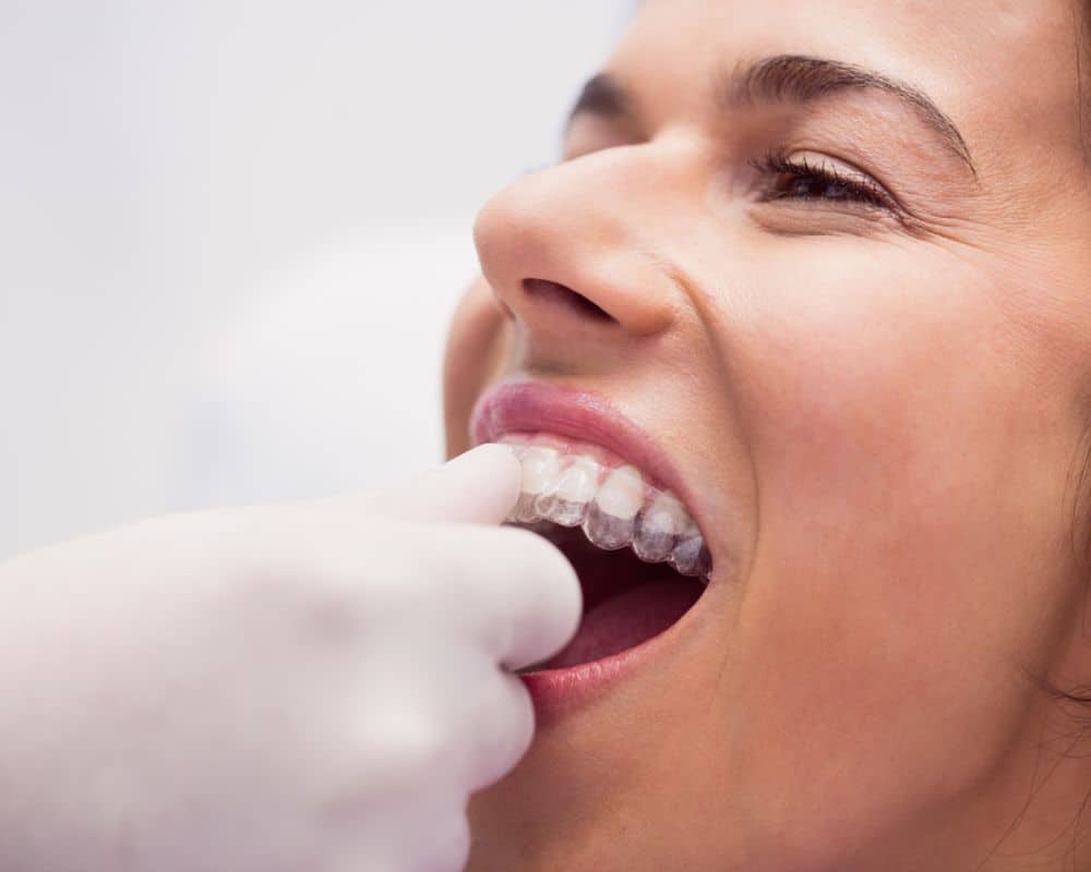 Invisalign brentwood