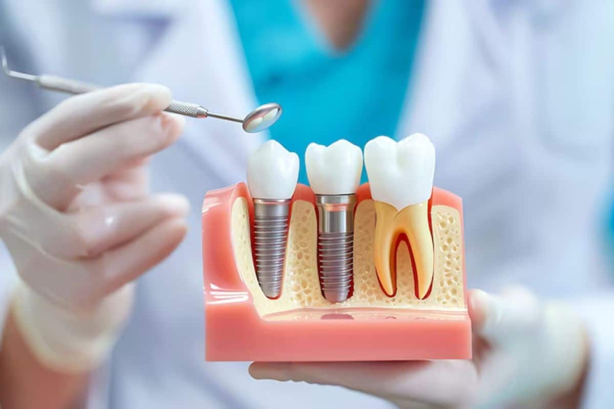 Implant Dentist Brentwood