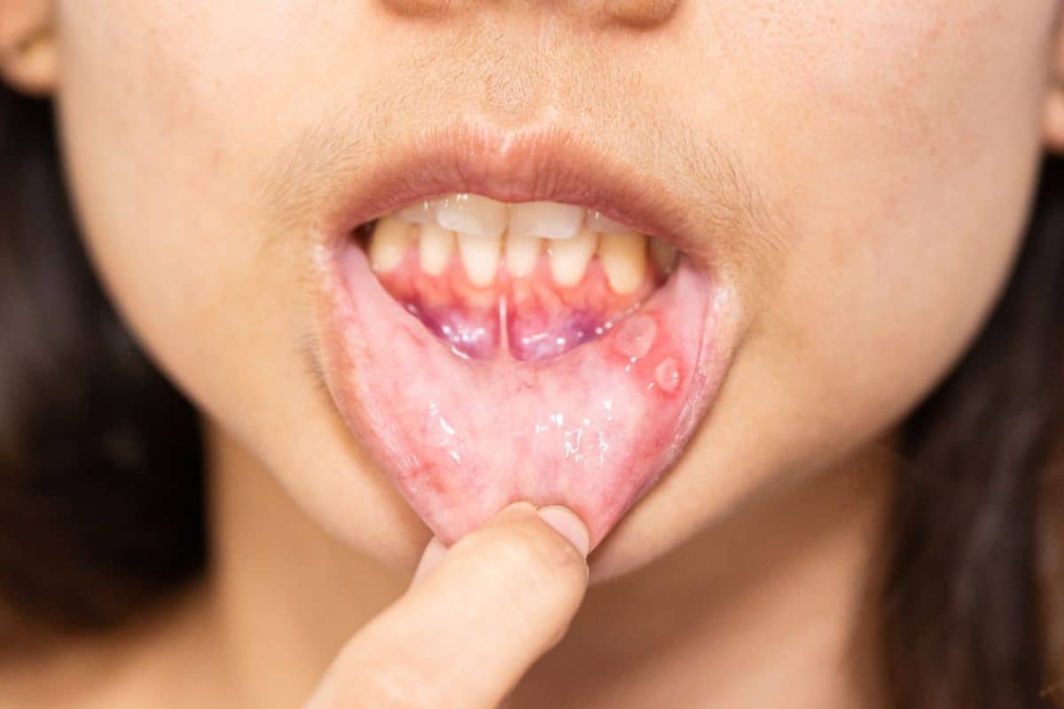 Mouth Ulcers Brentwood