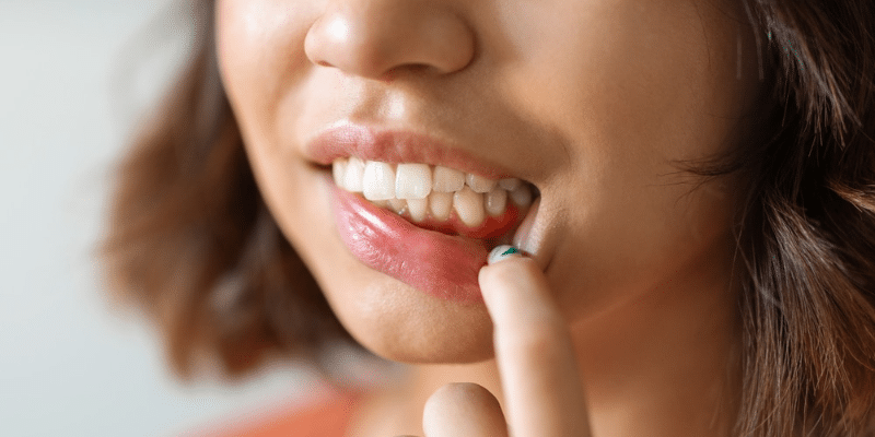 Vitamin Deficiencies That Cause Gum Sores