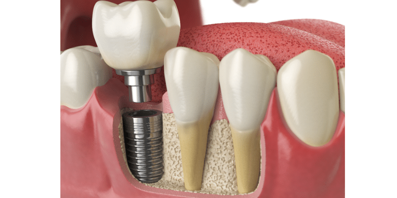 What Type of Dental Implant is Best