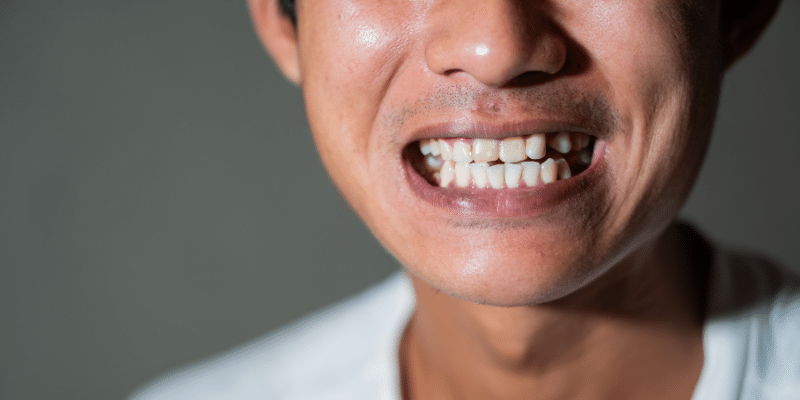 Know About Premature Tooth Loss