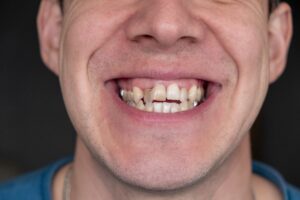 Adult with crooked and crowded teeth before Invisalign treatment