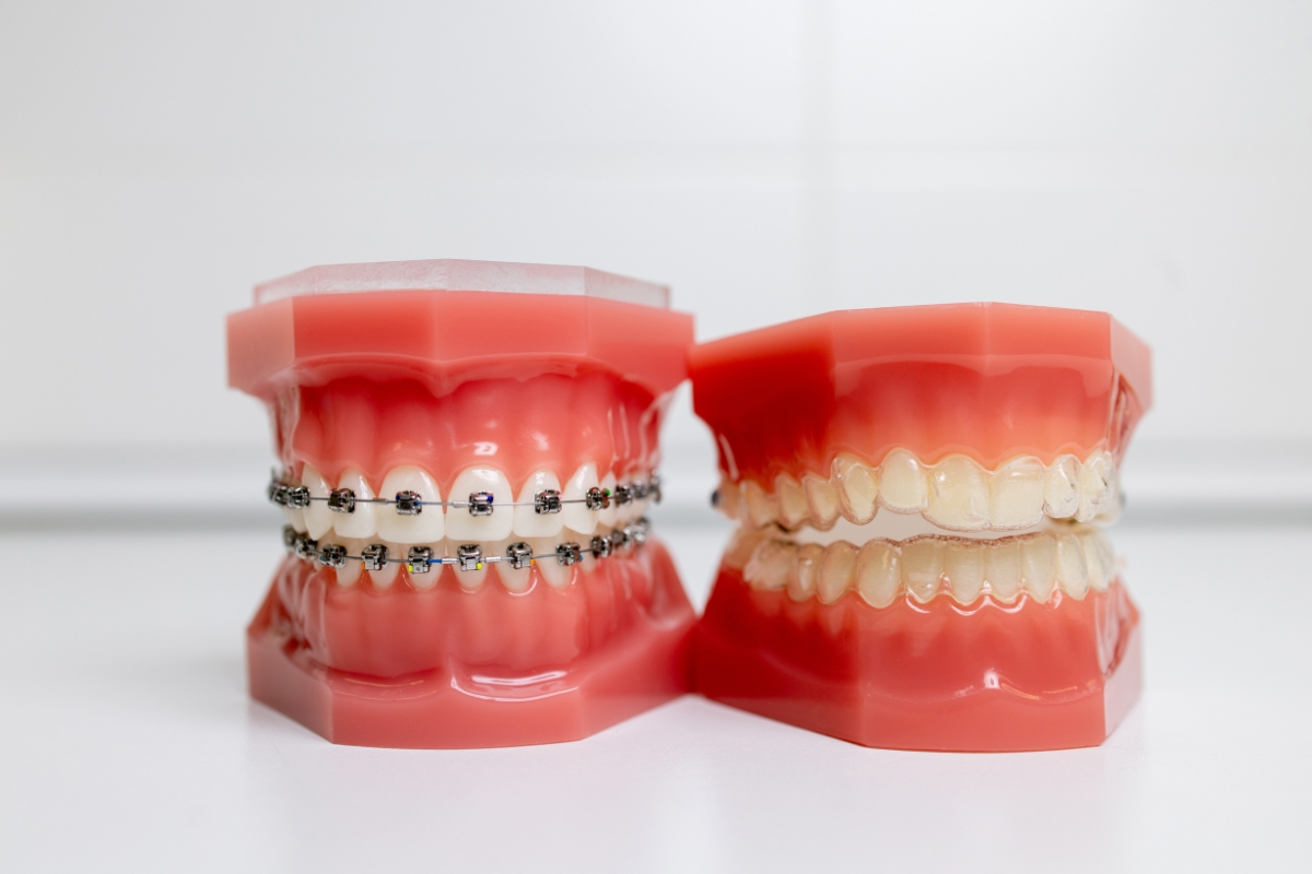 Braces and clear aligners used in orthodontic treatment to straighten teeth